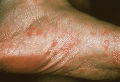 Secondary Syphilis Rash Photograph by Cnri/science Photo Library