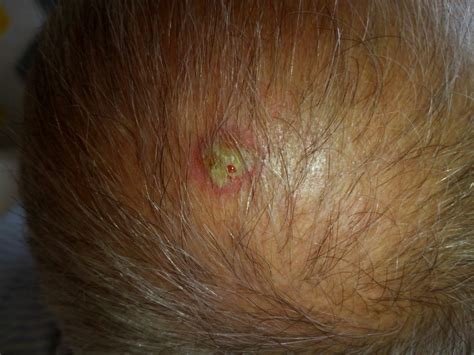 This lesion on the scalp has been growing for the past 4 weeks. In the ...