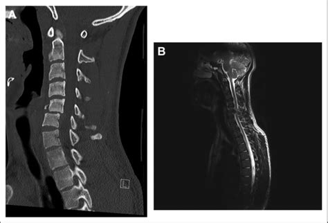 Preoperative computed tomography (A) and magnetic resonance tomography ...