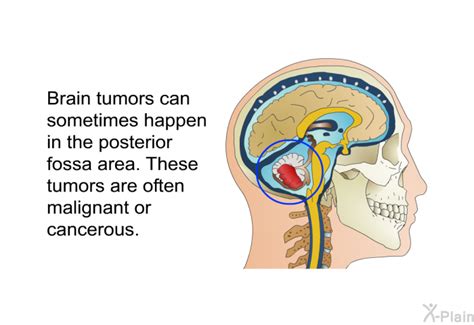 PatEdu.com : Posterior Fossa Craniotomy for Brain Tumors