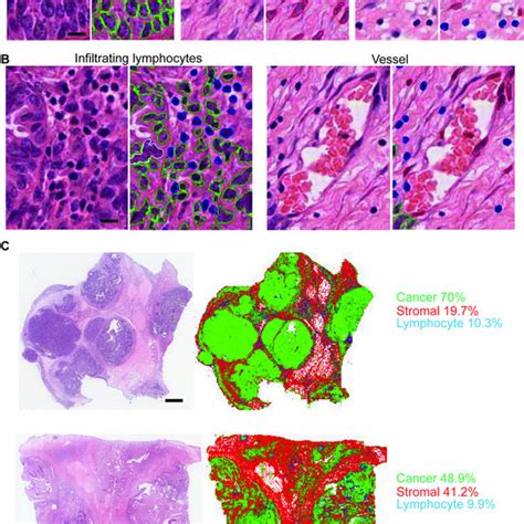 Image analysis for ovarian cancer histology sections.: (A) Cell nuclei ...