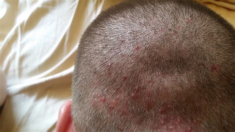 Scalp Acne/Folliculitis (Pictures) - General acne discussion - Acne.org ...