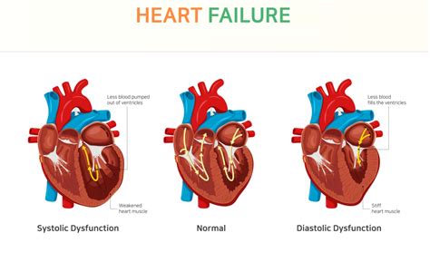 Diastolic heart failure: a failure to relax - Cardiocare