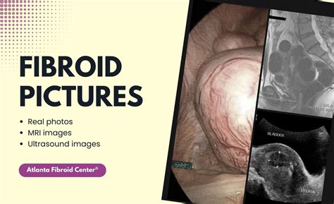 Real Pictures of Fibroids, MRI & Ultrasound Images [15 Pics]