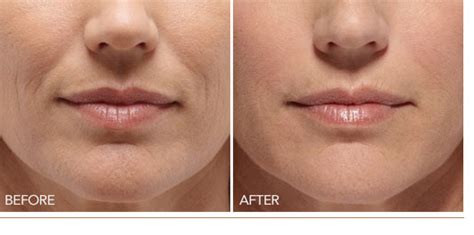 MG Medical & Aesthetics Facility | Wrinkle Fillers, Belotero - Radiesse ...