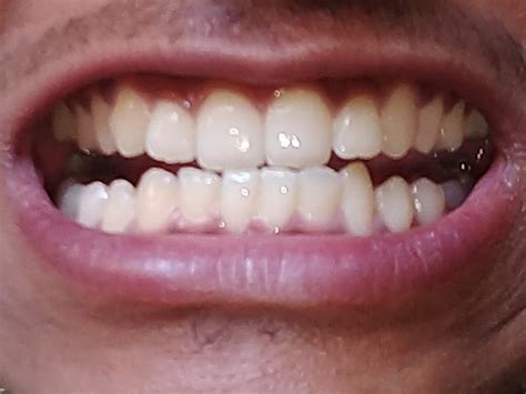 Normal teeth or bite problem? | Dentistry Forums