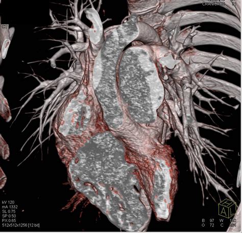 Enlarged Main Pulmonary Artery - Chest Case Studies - CTisus CT Scanning