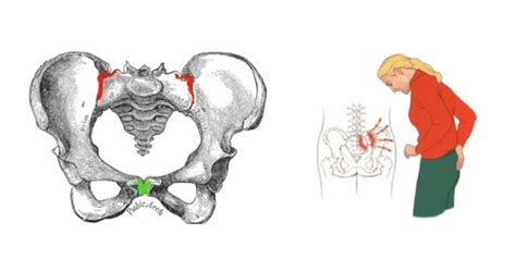 Symphysis Pubis Dysfunction (SPD)