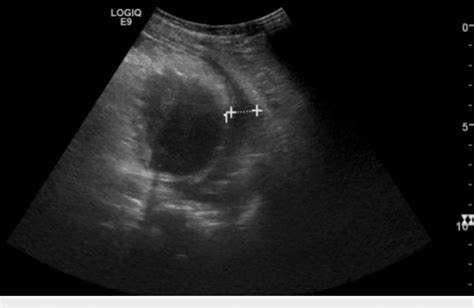 Chest ultrasound showing moderate to large pleural effusion. | Download ...