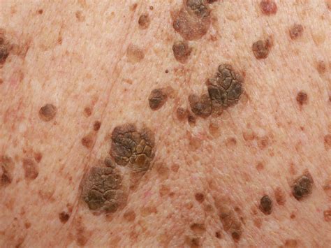 Seborrheic Keratosis - Causes, Symptoms, Home Treatment