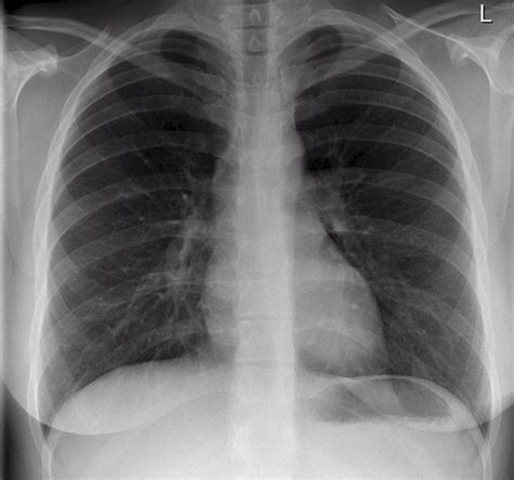 Reading The Chest X-Ray (Chest Radiography): Identifying A Normal Chest ...