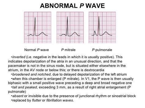 Ecg lecture