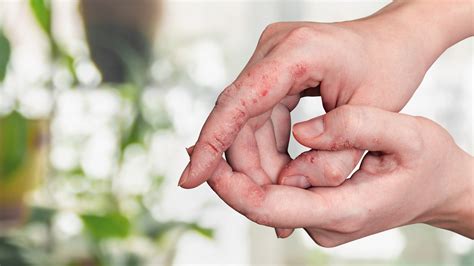 Eczema vs. Scabies: Symptoms and Photos - GoodRx