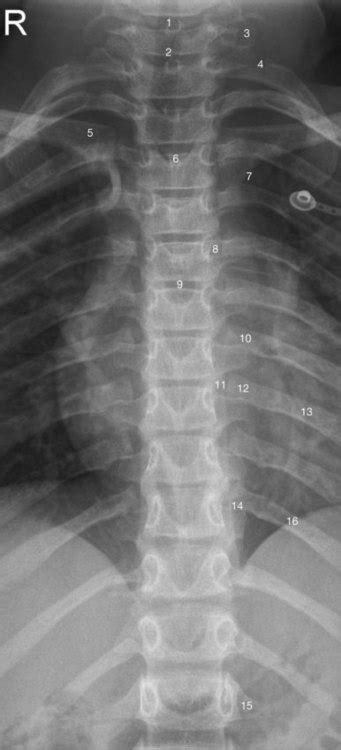 The spinal column and its contents | Radiology Key