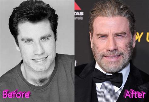 John Travolta Plastic Surgery: The Fear Of Getting Old?