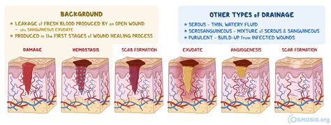 Sanguineous Drainage: What Is It, Appearance, and More | Osmosis