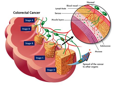 Newsroom Biomarker discovery offers clearer prognosis for bowel and ...