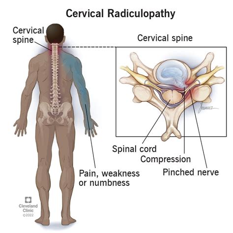 Cervical Radiculopathy (Pinched Nerve in Neck): Symptoms & Treatment