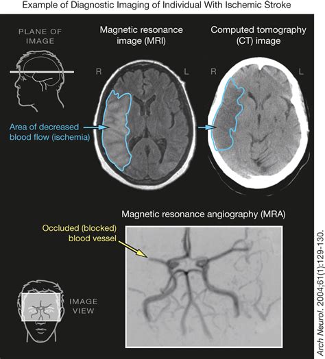 Stroke Imaging | Cerebrovascular Disease | JAMA | JAMA Network