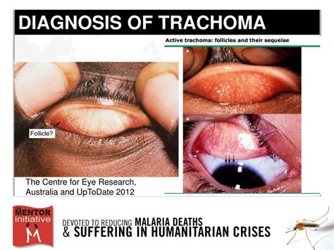 PPT - Trachoma: Diagnosis, Treatment, & Prevention Melina Lopez ...