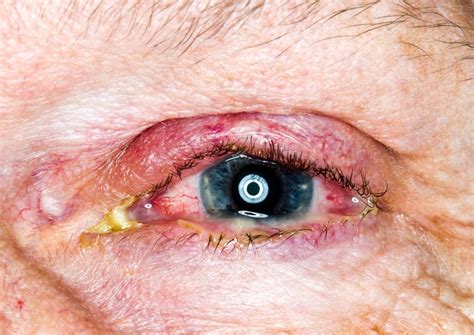 Eye Discharge: Causes, Symptoms, and Home Treatments