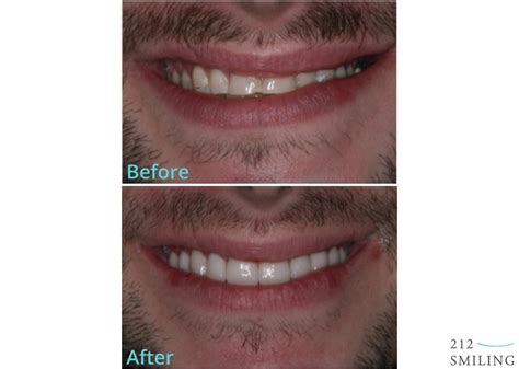 Veneers Before and After Male - 212 Smiling