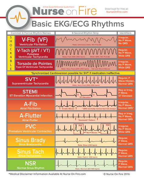 EKG Rhythm - EKG Made Easy - Basic EKG/ECG Rhythms V-Fib (VF) V-Tach ...