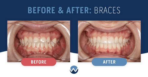 Before & After Braces: See the Amazing Results Yourself! • Woodhill ...