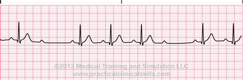 Second Degree Heart Block Type II ECG Interpretation with Sample Strip