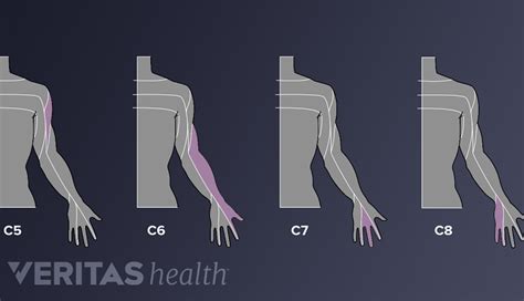 Cervical Herniated Disc Signs and Symptoms | Spine-health