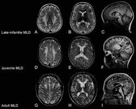 Metachromatic leukodystrophy - MEDizzy