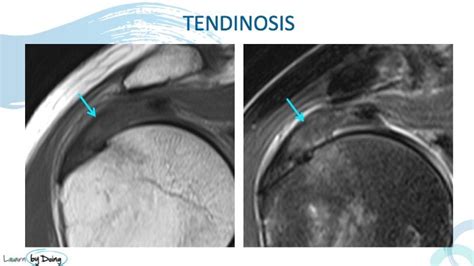 MRI Rotator Cuff Tendinosis Vs Tears | Radedasia