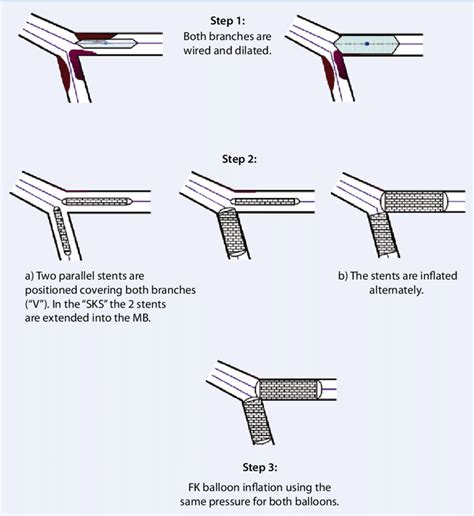 Kissing Iliac Stents