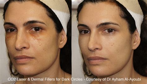 CO2 Laser Skin Resurfacing London, Before & After Pics (UK’s Best Clinic)