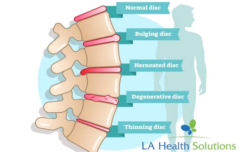 What Is Degenerative Disc Disease? | LA Health Solutions