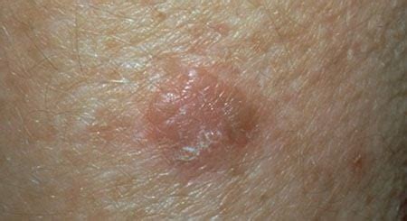 Squamous Cell Carcinoma - Skin Cancer & Dermatology Center of Colorado ...