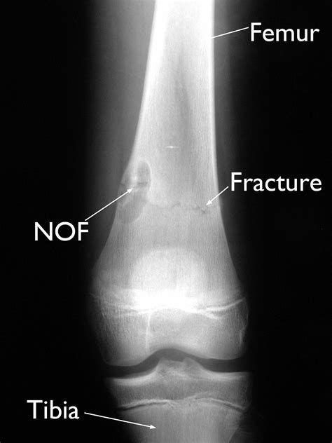 Nonossifying Fibroma - OrthoInfo - AAOS