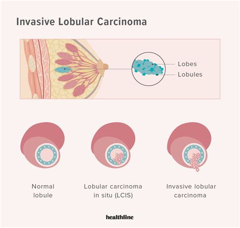 Types of Breast Cancer: Common Types, Other Types, Stats