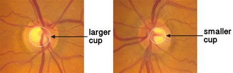 Ch 4 Types of Glaucoma. A Patient's Guide to Glaucoma