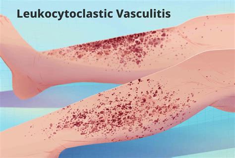 Causes of Skin Changes in Leukocytoclastic Vasculitis