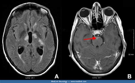 Cryptococcus Brain