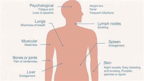 Leukemia Children Symptoms