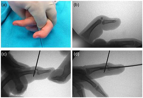 The Diagnosis and Management of Mallet Finger Injuries - Gregory A ...