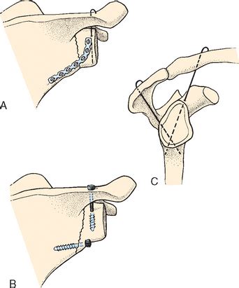 Fractures of the Scapula | Musculoskeletal Key