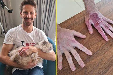 Formula One star Romain Grosjean shows off gruesome hand injuries to ...