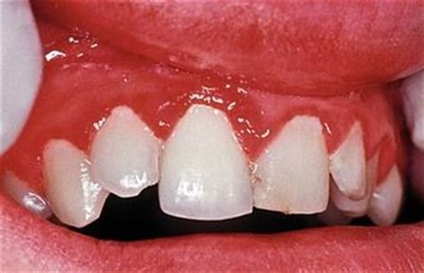 Linear Gingival Erythema