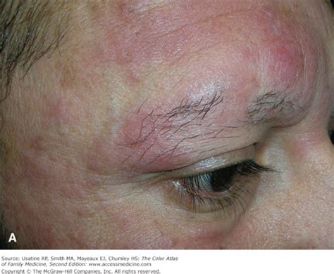 Cutaneous T-Cell Lymphoma | Basicmedical Key