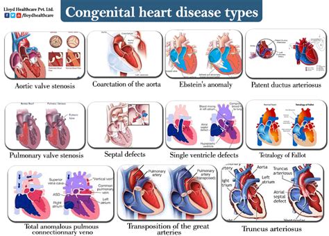 heart disease - Congenital Heart Defect