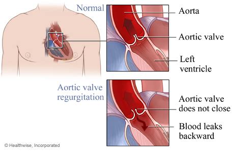 Aortic Regurgitation