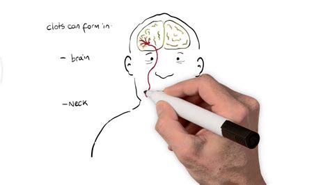 What is a Stroke? Animated Explanation Video | Explanation video ...